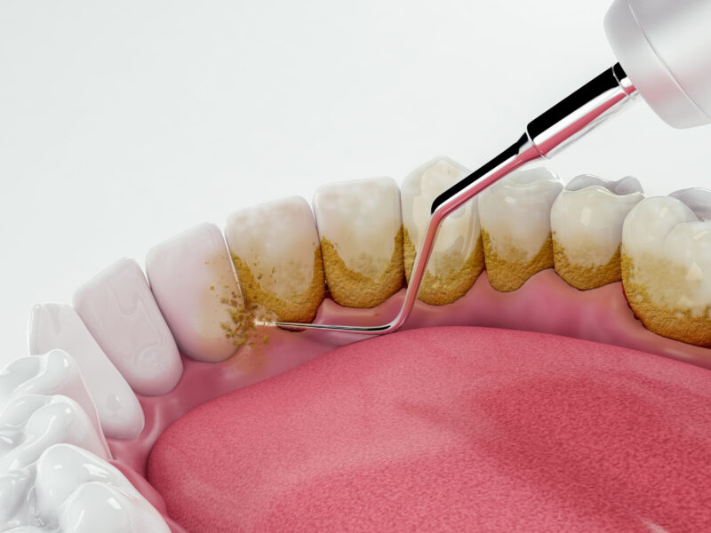 Dental cleaning removing plaque and dirt on the teeth; 3D; 3D Illustration